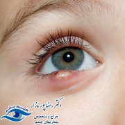 آیا عفونت چشم در نوزادان خطرناک است