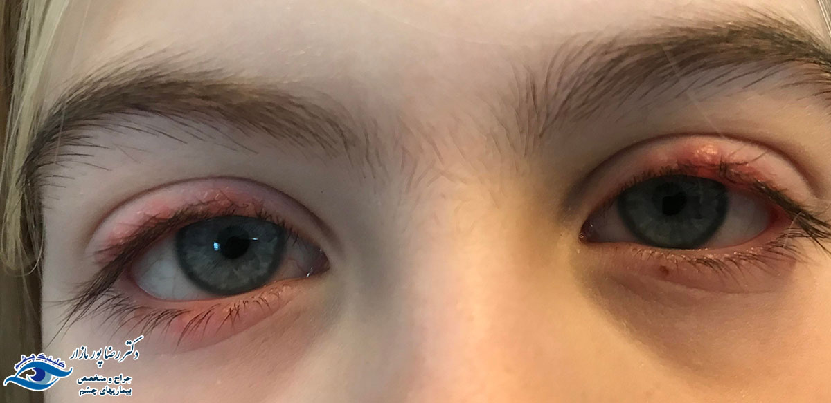 آیا عفونت چشم در نوزادان خطرناک است