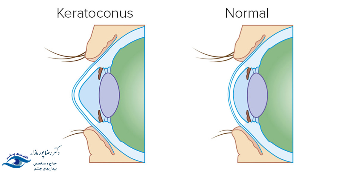 کراتوکونوس یک بیماری کمتر شناخته شده چشم