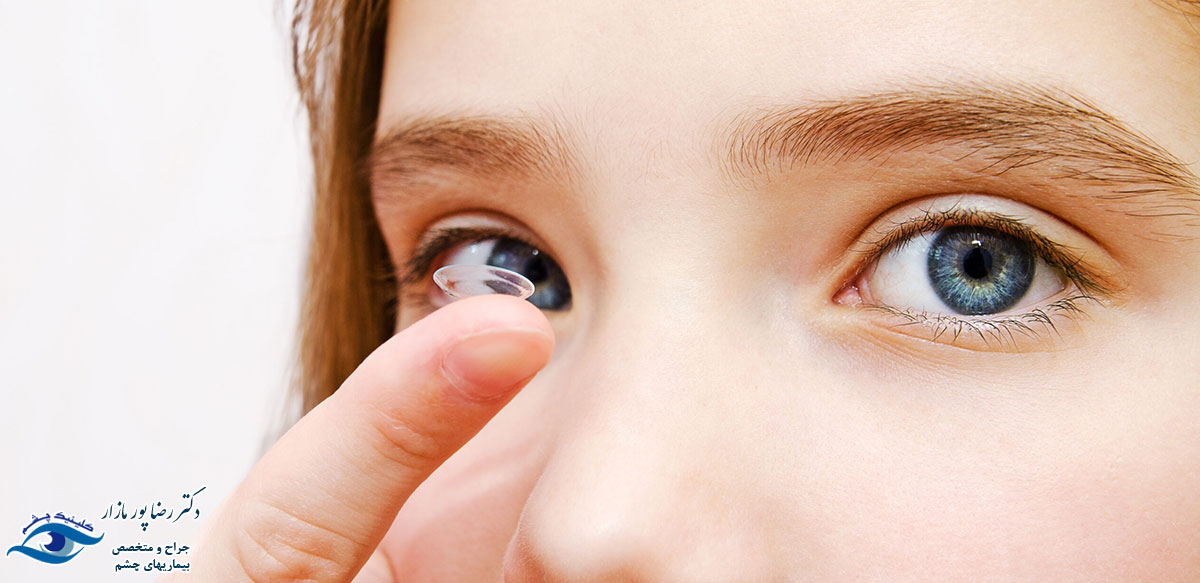 عفونت چشمی ناشی از لنز تماسی