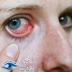 انواع عفونت چشم و راه های درمان آن