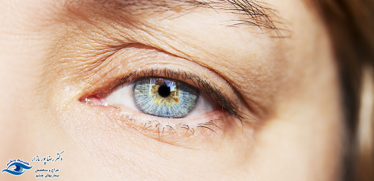 خطر افتادگی پلک چشم
