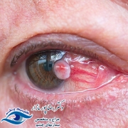 سرطان چشم چیست؟