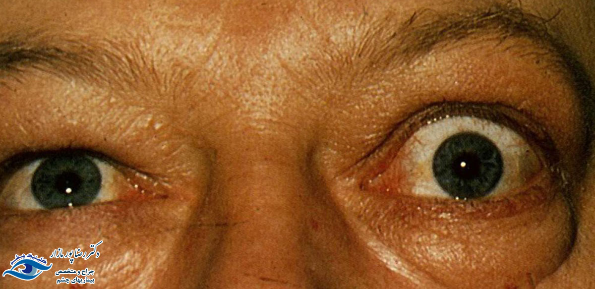 درمان تومور اربیت چشمی