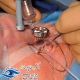 جراحی ویترکتومی عمیق چیست