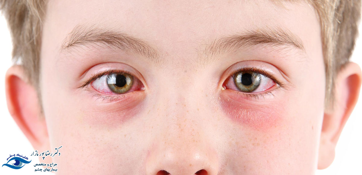 علائم آلرژی چشم