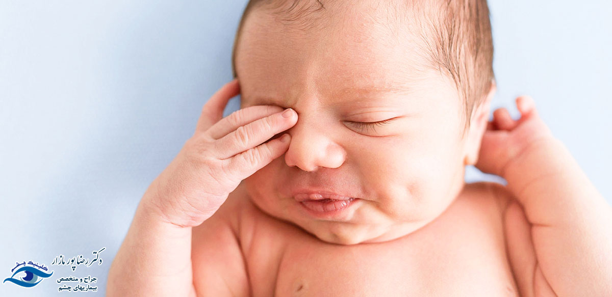 درمان انسداد مجرای اشکی در نوزادان
