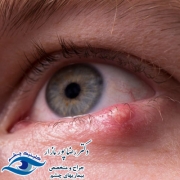 مراقبت های قبل و بعد از عمل شالازیون چشم