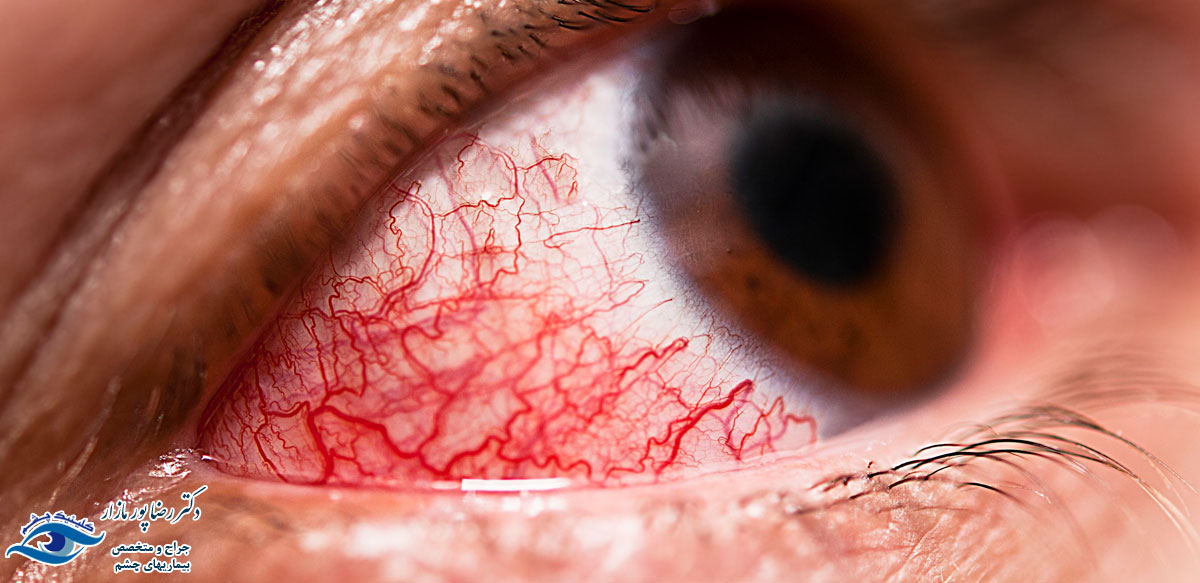 بیماری اسکلریت چشم