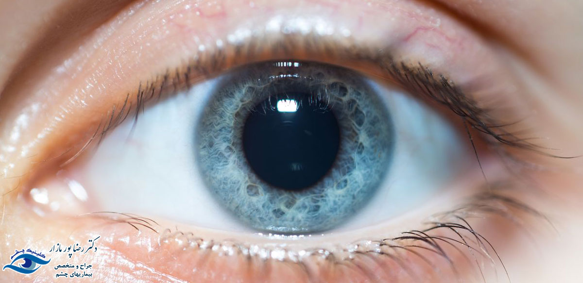 درمان گشادی مردمک چشم