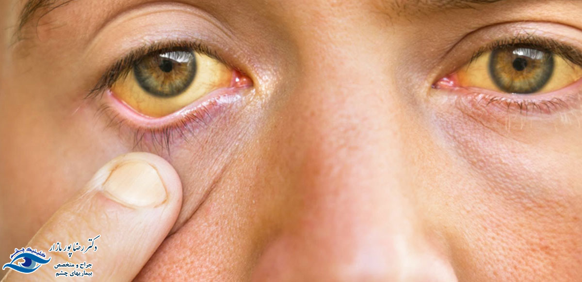 علت زردی چشم در بزرگسالان