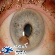 رادیوتراپی چشم