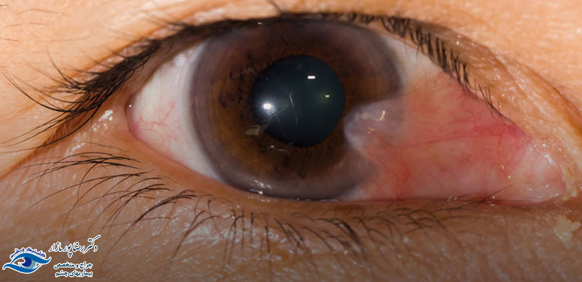 تشخیص و درمان ناخنک چشم