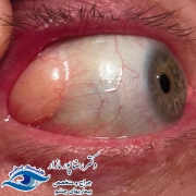 درمان تومور لیپوترموئید چشم