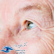علائم‌ پیر چشمی