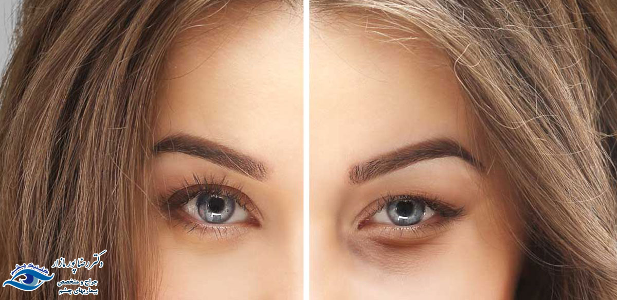 عمل زیبایی چشم چیست