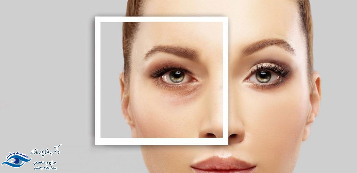 عمل زیبایی چشم چیست