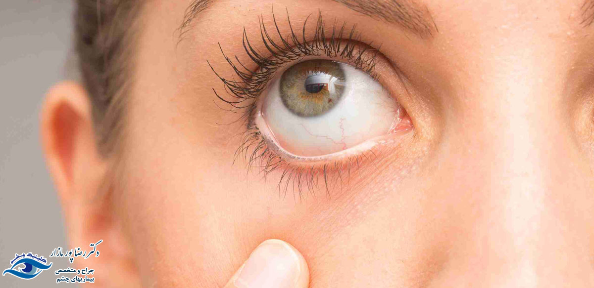 خشکی چشم و درمان آن