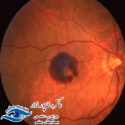 دژنراسیون شبکیه چشم