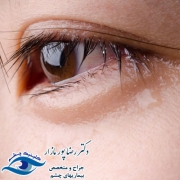 درمان اشک ریزش ناگهانی