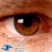 سرطان چشم و علائم آن