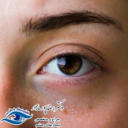 جدا شدگی شبکیه چیست