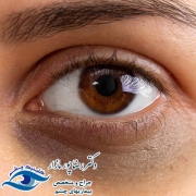 علت سیاهی دور چشم چیست