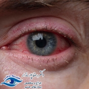 عفونت چشم چیست