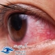 علت خونریزی چشمی