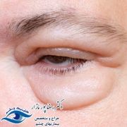 ورم چشم و درمان