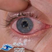 خراش قرنیه چیست