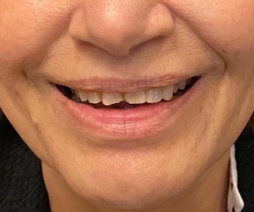 قبل از تزریق ژل حجم دهنده